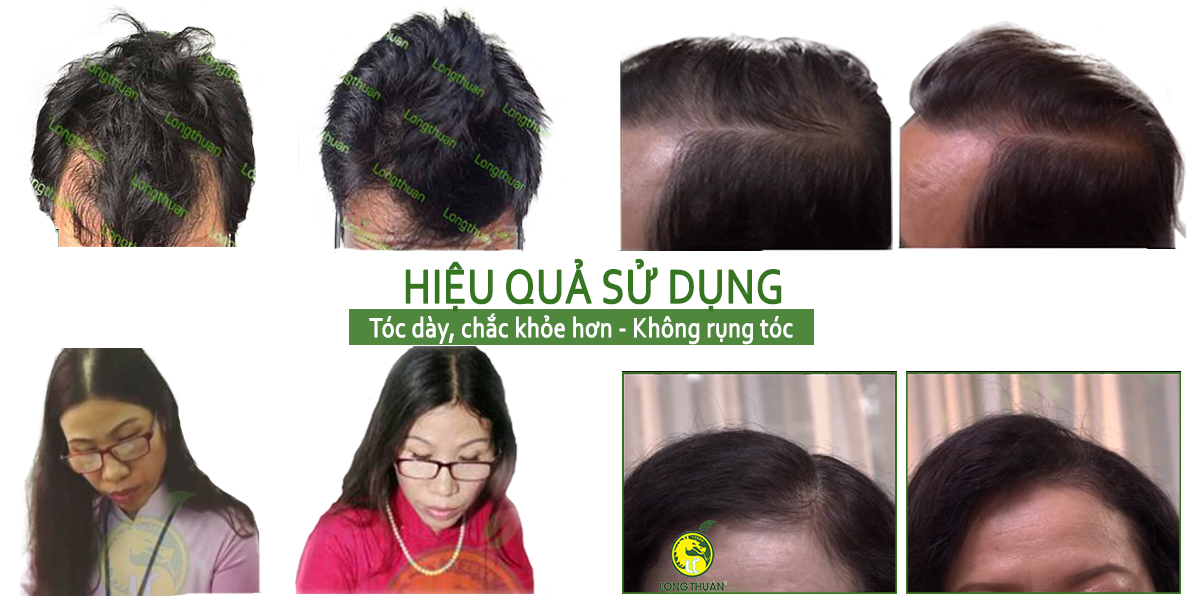 TRƯỚC VÀ SAU KHI SỬ DỤNG TINH DẦU HOA BƯỞI MỌC TÓC LONG THUẬN