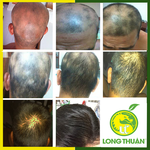 TINH DẦU HOA BƯỞI LONG THUẬN GIÚP TRỊ HÓI ĐẦU MỌC TÓC ĐƯỢC KHÔNG?